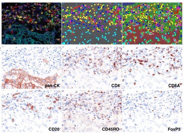 图16 NSCLC 多重荧光染色及单色拆分（pan-CK / CD4 / CD8
